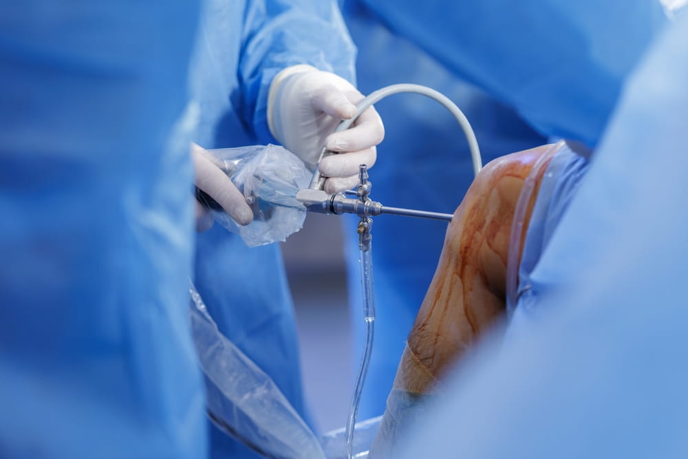 Surgeons perform knee arthroscopy with PCL reconstruction using arthroscope and portals on blue sterile drapes authentic minimally invasive orthopedic surgery